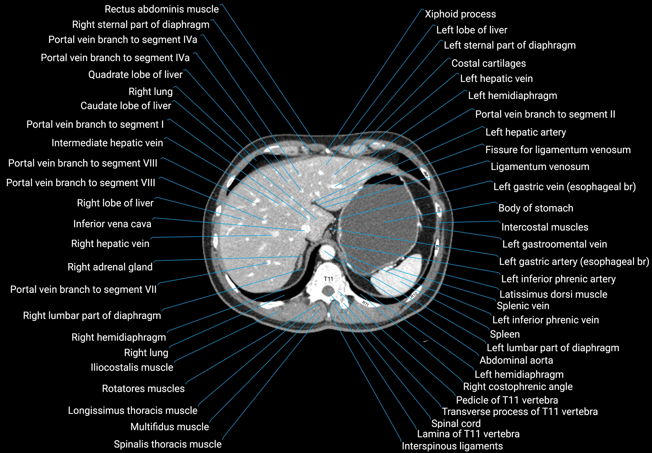 CT male pelvis axial cross sectional anatomy labelled radiology image -00028.webp